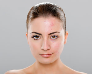 Image of woman with acne